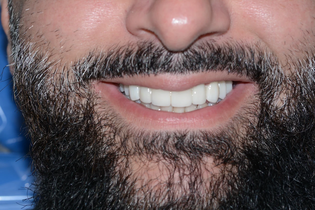 After smile transformation treatment at SmilePro Dental, Dearborn Heights MI