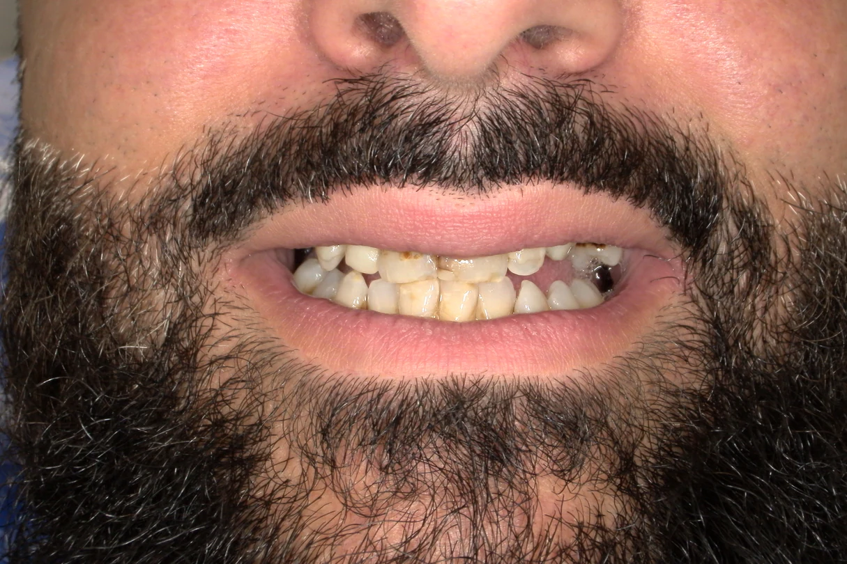 Before smile transformation treatment at SmilePro Dental, Dearborn Heights MI