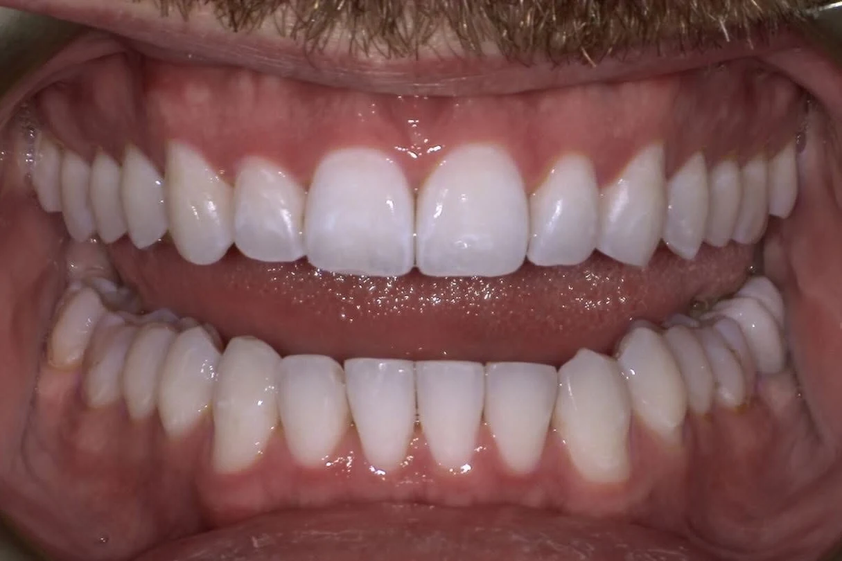 After smile transformation treatment at SmilePro Dental, Dearborn Heights MI