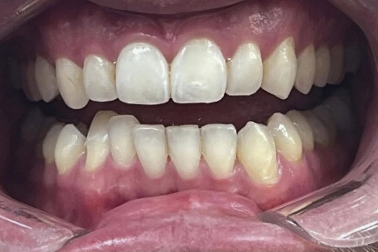 Before smile transformation treatment at SmilePro Dental, Dearborn Heights MI