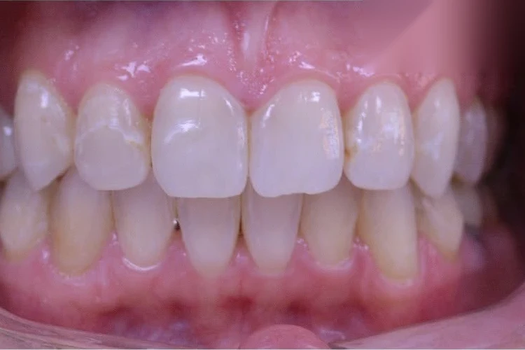 After invisalign treatment at SmilePro Dental, Dearborn Heights MI