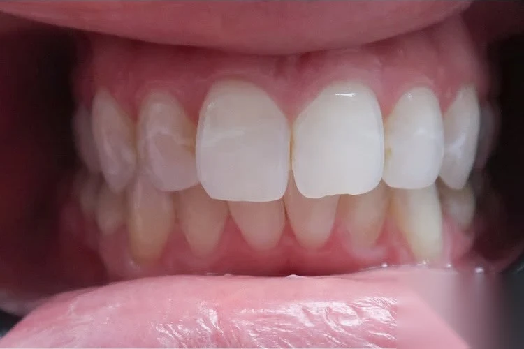Before invisalign treatment at SmilePro Dental, Dearborn Heights MI