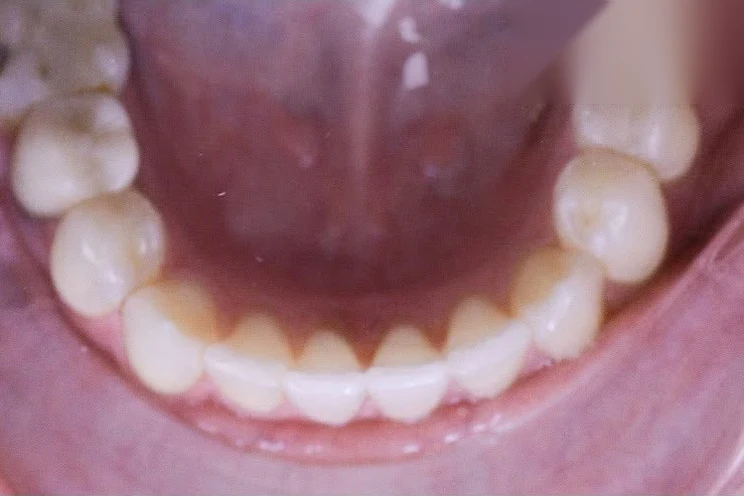 After invisalign treatment at SmilePro Dental, Dearborn Heights MI