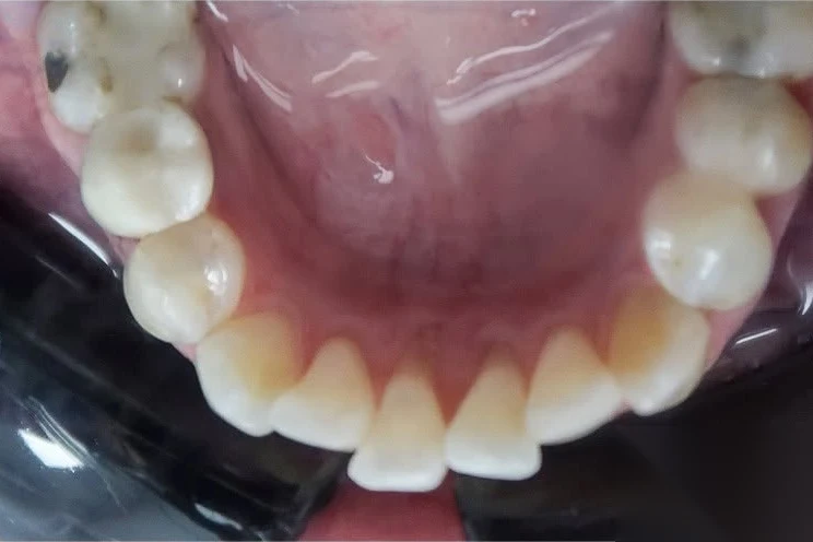 Before invisalign treatment at SmilePro Dental, Dearborn Heights MI