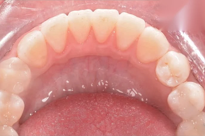 After invisalign treatment at SmilePro Dental, Dearborn Heights MI