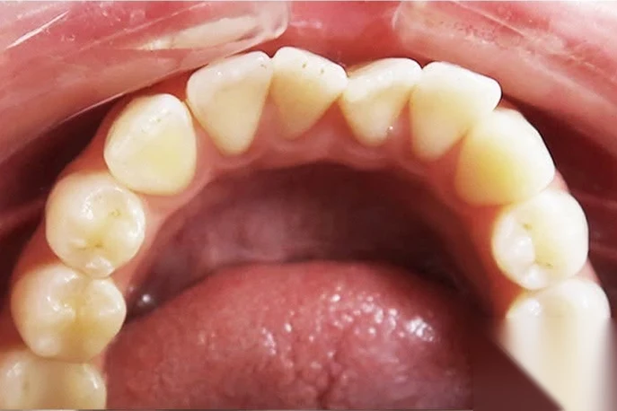 Before invisalign treatment at SmilePro Dental, Dearborn Heights MI