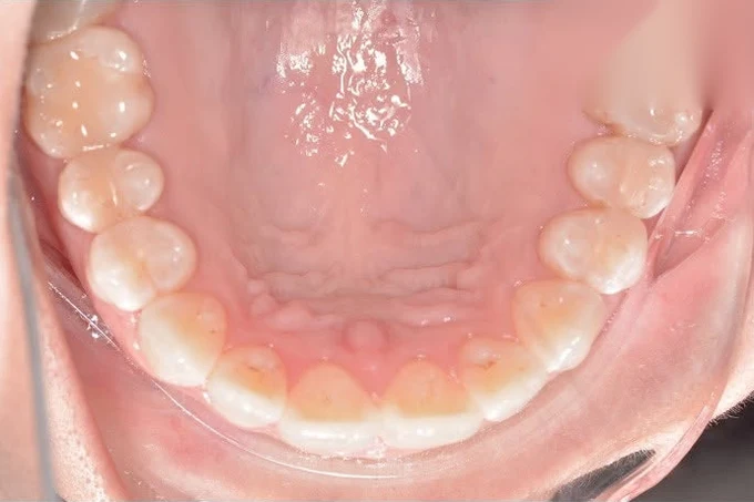 After invisalign treatment at SmilePro Dental, Dearborn Heights MI