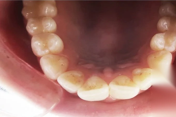 Before invisalign treatment at SmilePro Dental, Dearborn Heights MI