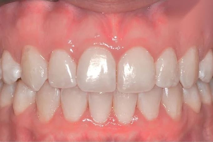 After invisalign treatment at SmilePro Dental, Dearborn Heights MI
