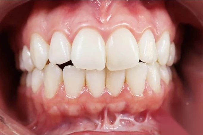 Before invisalign treatment at SmilePro Dental, Dearborn Heights MI