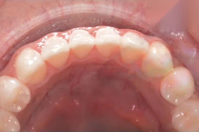 After invisalign treatment at SmilePro Dental, Dearborn Heights MI