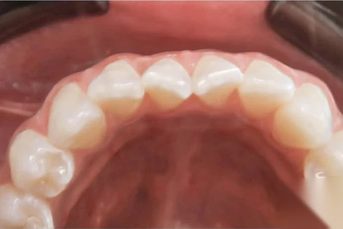 Before invisalign treatment at SmilePro Dental, Dearborn Heights MI