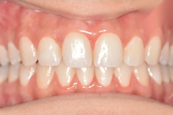 After invisalign treatment at SmilePro Dental, Dearborn Heights MI