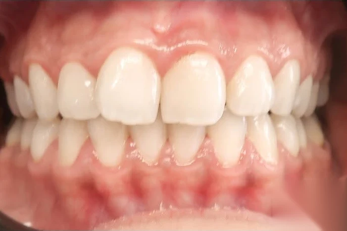 Before invisalign treatment at SmilePro Dental, Dearborn Heights MI