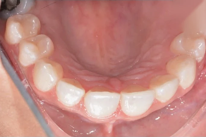 After invisalign treatment at SmilePro Dental, Dearborn Heights MI