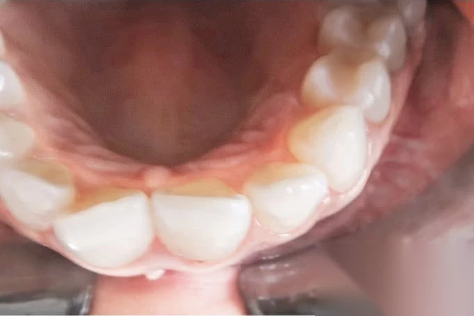 Before invisalign treatment at SmilePro Dental, Dearborn Heights MI