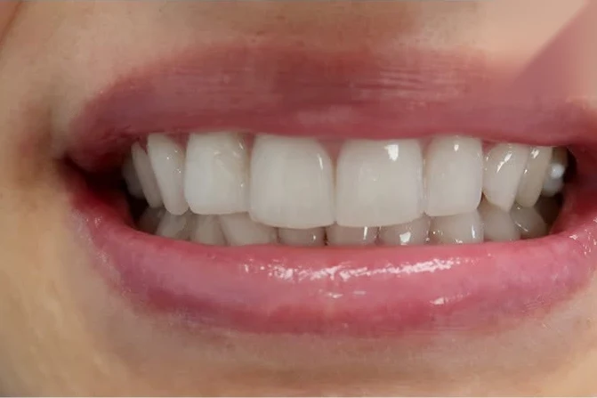 After teeth whitening treatment at SmilePro Dental, Dearborn Heights MI