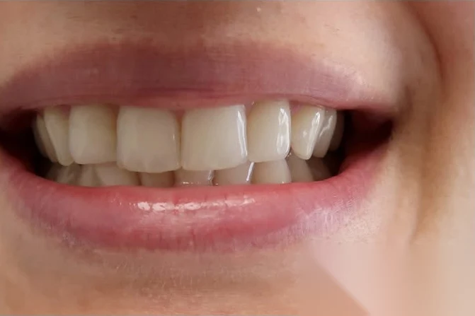 Before teeth whitening treatment at SmilePro Dental, Dearborn Heights MI
