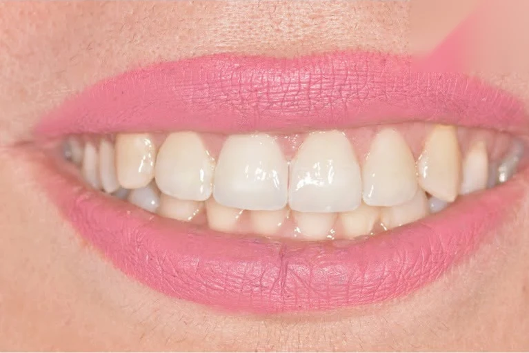 After smile transformation treatment at SmilePro Dental, Dearborn Heights MI