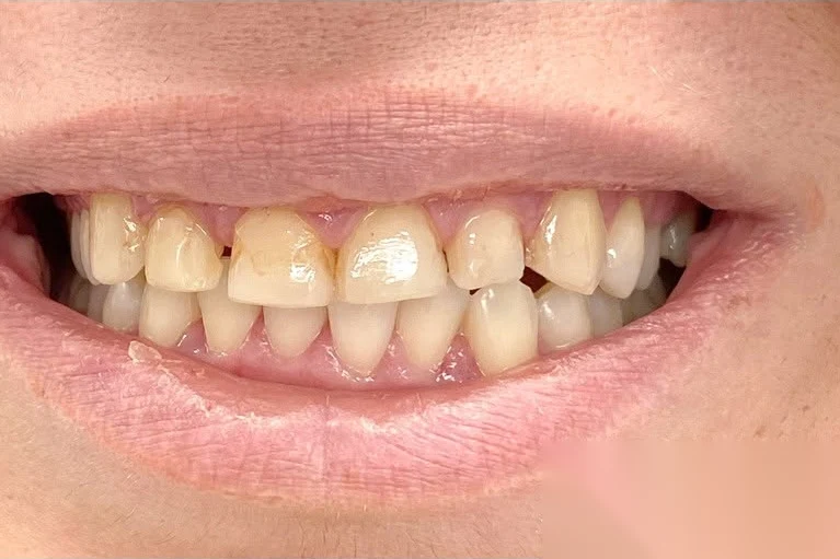 Before smile transformation treatment at SmilePro Dental, Dearborn Heights MI