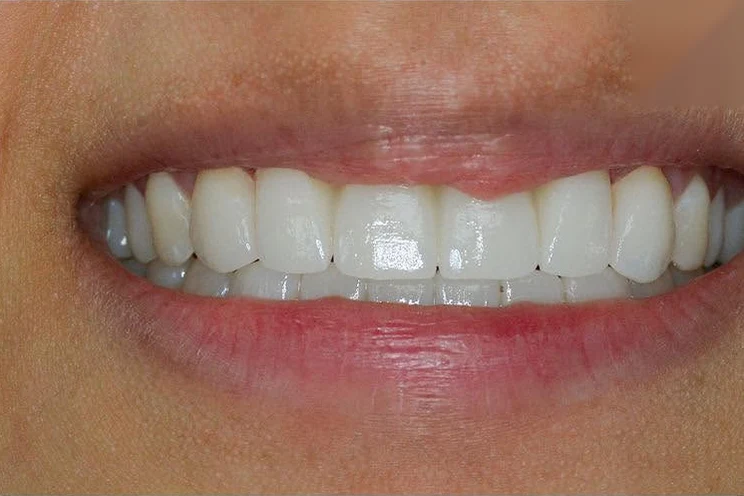 After smile transformation treatment at SmilePro Dental, Dearborn Heights MI