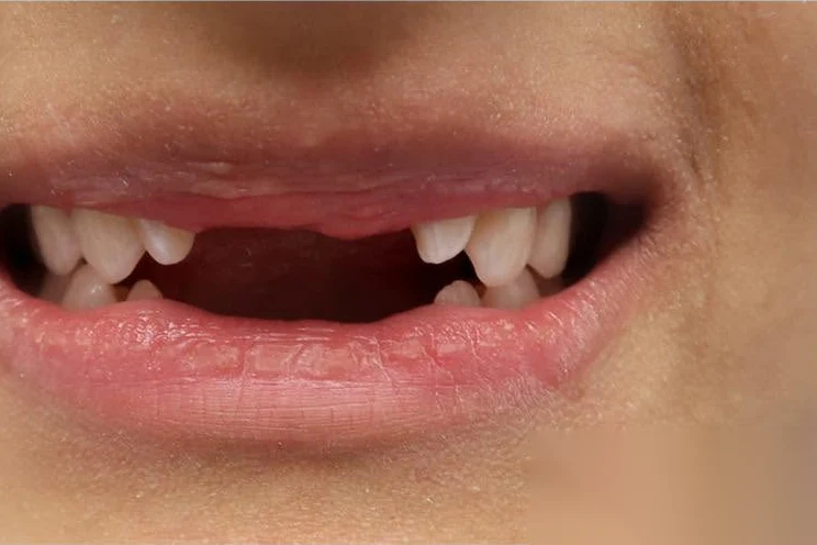 Before smile transformation treatment at SmilePro Dental, Dearborn Heights MI