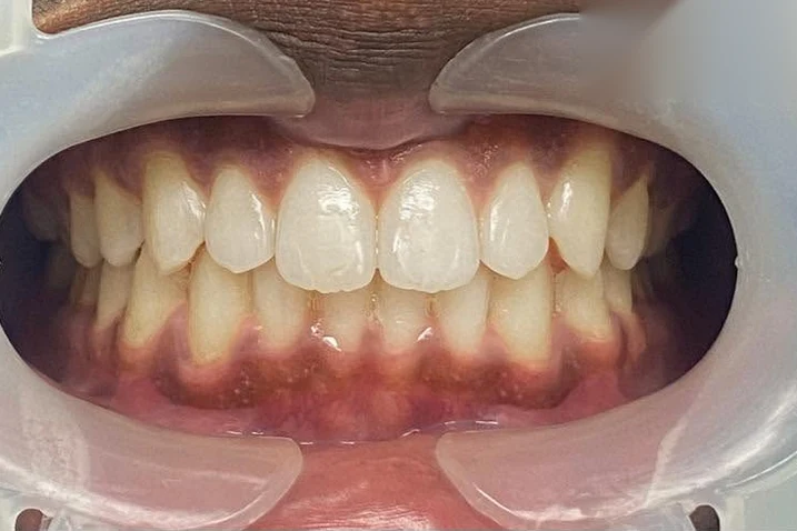 After smile transformation treatment at SmilePro Dental, Dearborn Heights MI