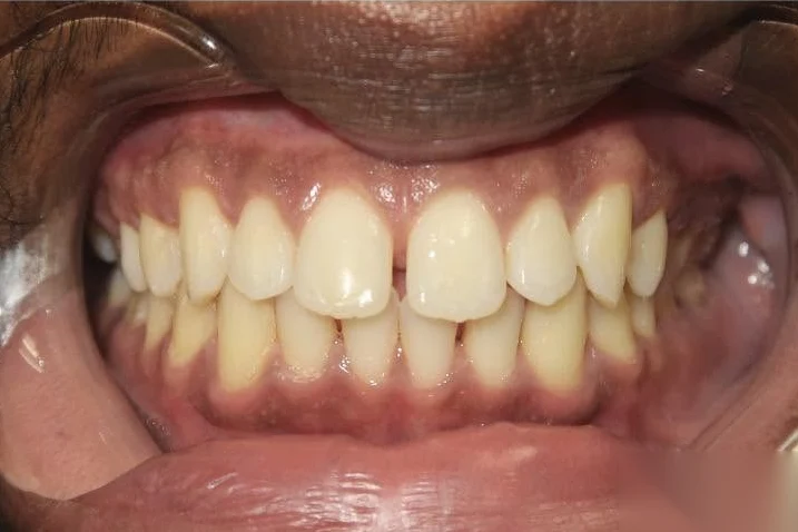 Before smile transformation treatment at SmilePro Dental, Dearborn Heights MI