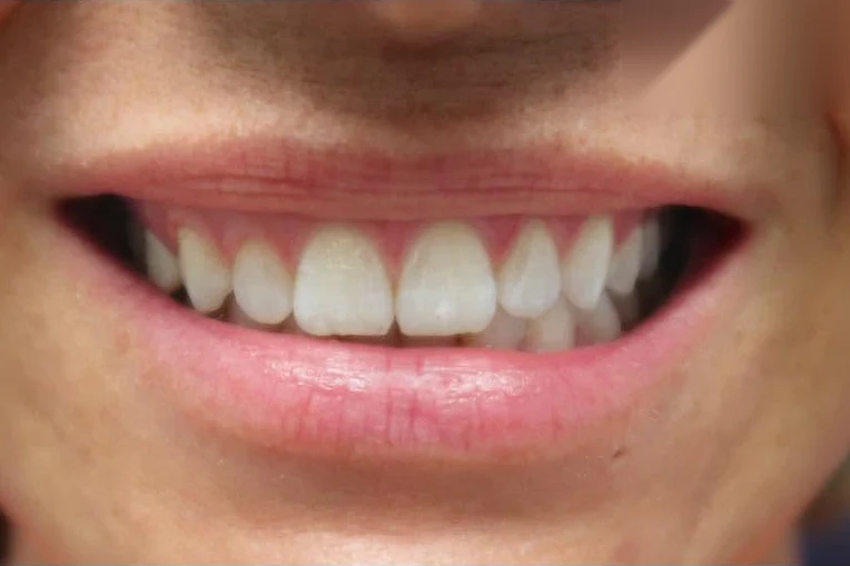 After smile transformation treatment at SmilePro Dental, Dearborn Heights MI