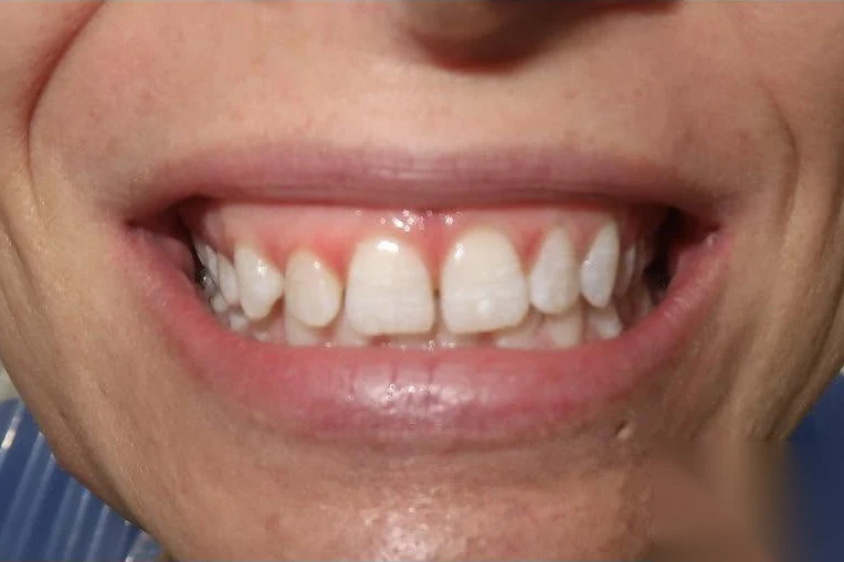 Before smile transformation treatment at SmilePro Dental, Dearborn Heights MI