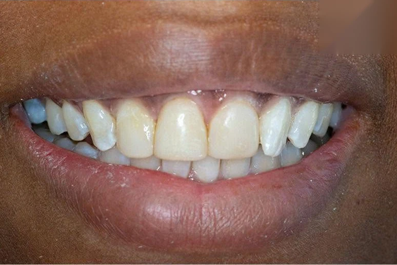 After composite bonding treatment at SmilePro Dental, Dearborn Heights MI
