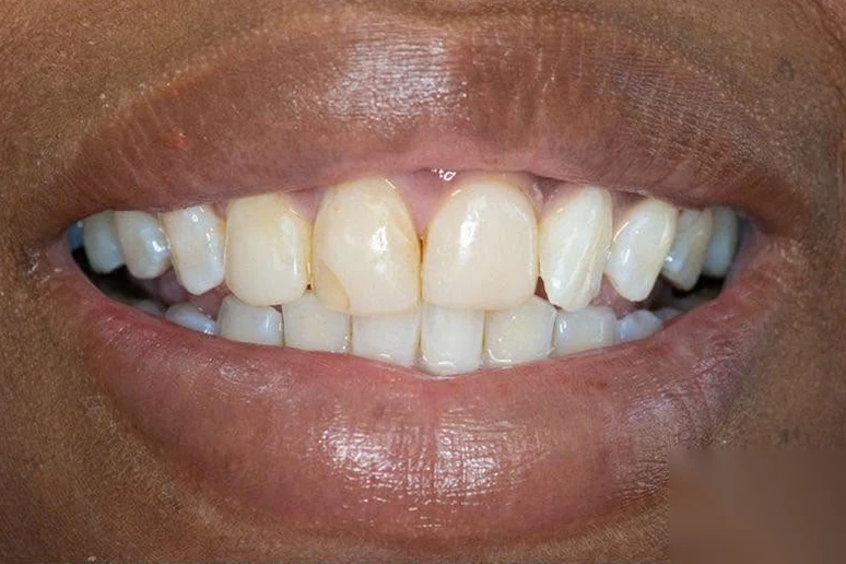 Before composite bonding treatment at SmilePro Dental, Dearborn Heights MI