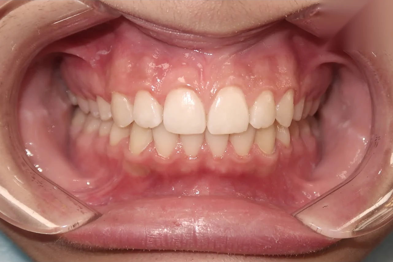 After smile transformation treatment at SmilePro Dental, Dearborn Heights MI