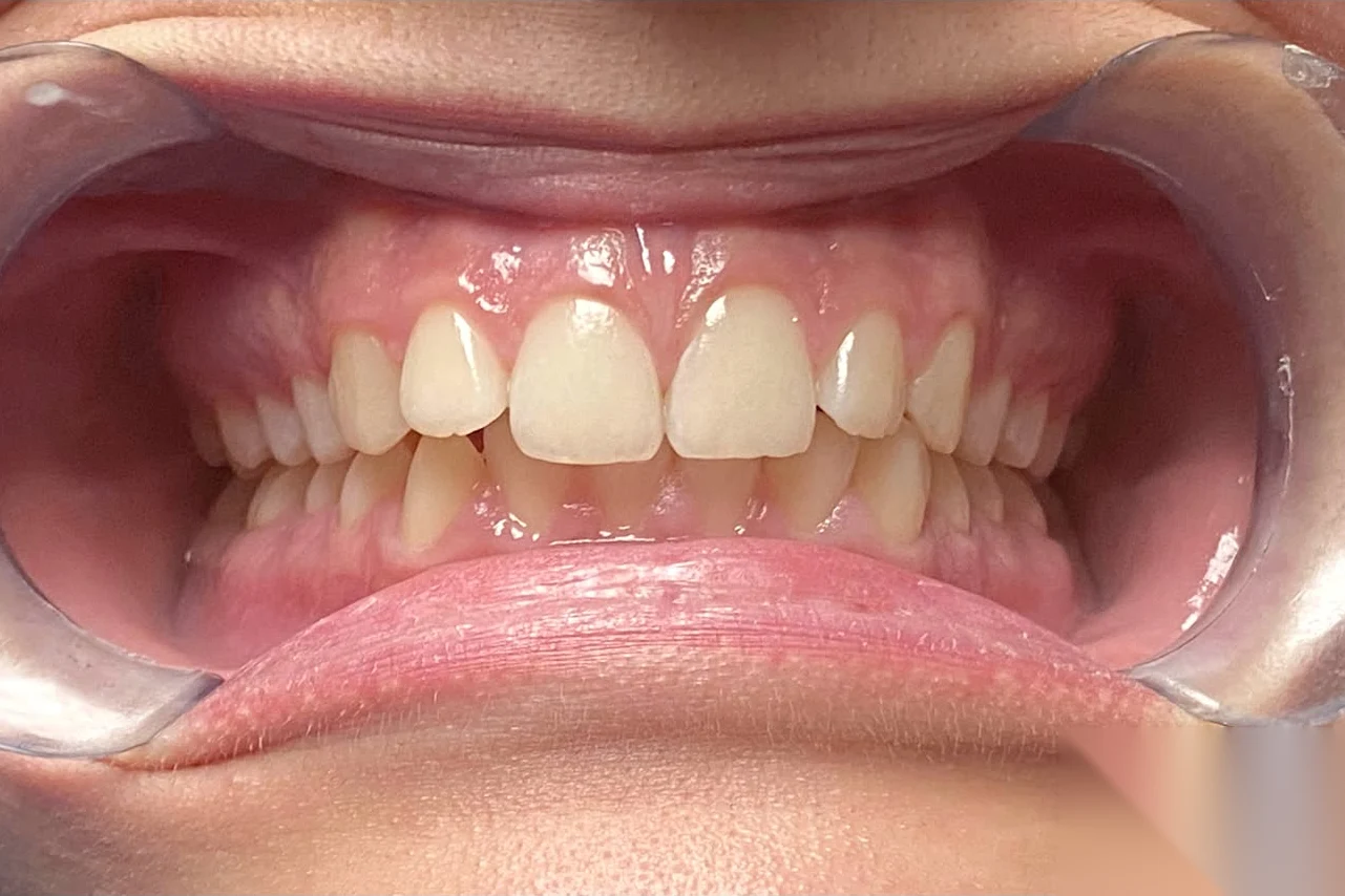 Before smile transformation treatment at SmilePro Dental, Dearborn Heights MI
