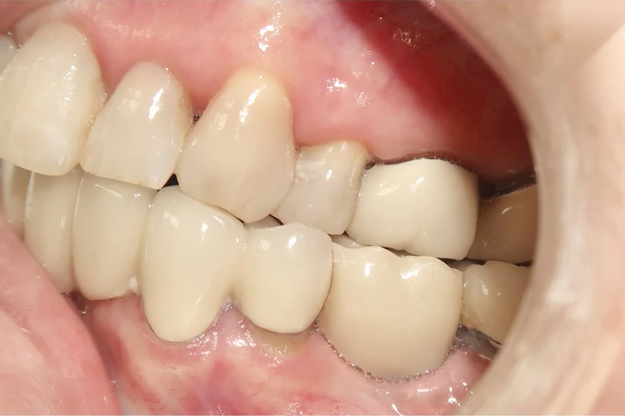 After smile transformation treatment at SmilePro Dental, Dearborn Heights MI