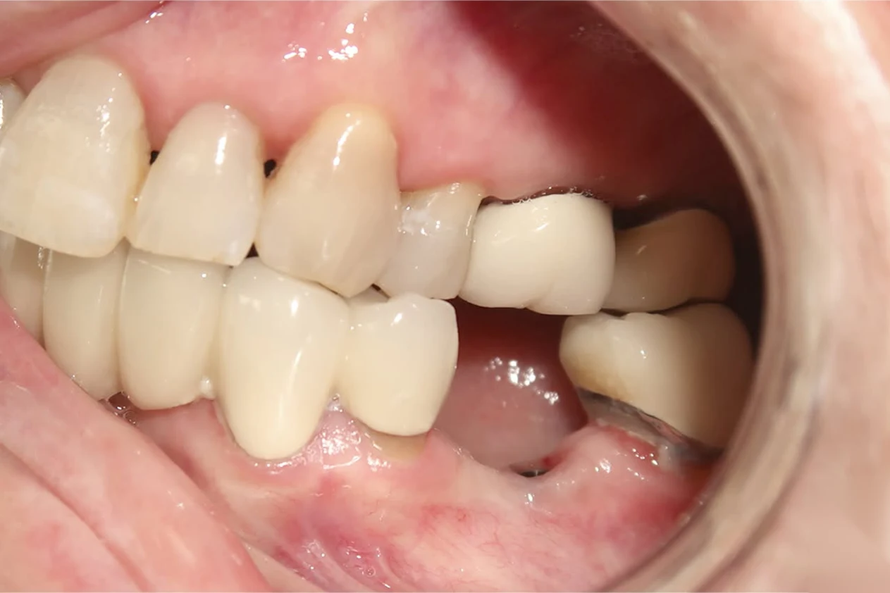 Before smile transformation treatment at SmilePro Dental, Dearborn Heights MI