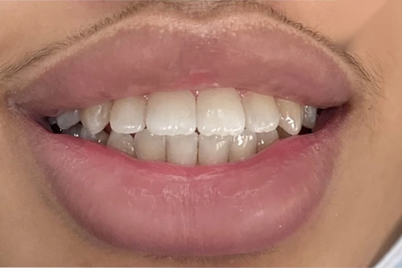 After smile transformation treatment at SmilePro Dental, Dearborn Heights MI
