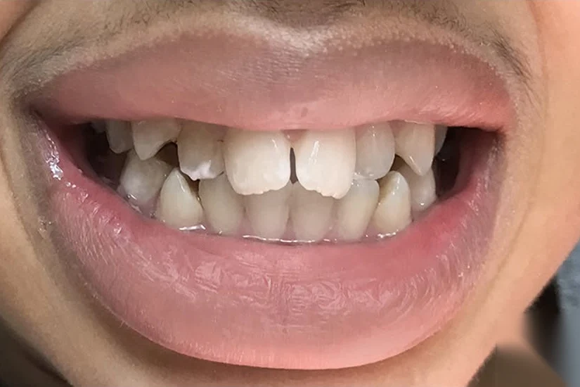 Before smile transformation treatment at SmilePro Dental, Dearborn Heights MI