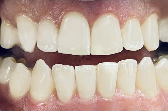 After smile transformation treatment at SmilePro Dental, Dearborn Heights MI