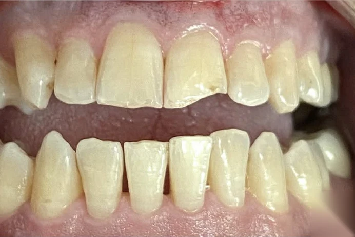 Before smile transformation treatment at SmilePro Dental, Dearborn Heights MI