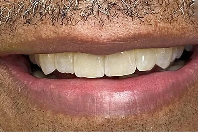After smile transformation treatment at SmilePro Dental, Dearborn Heights MI