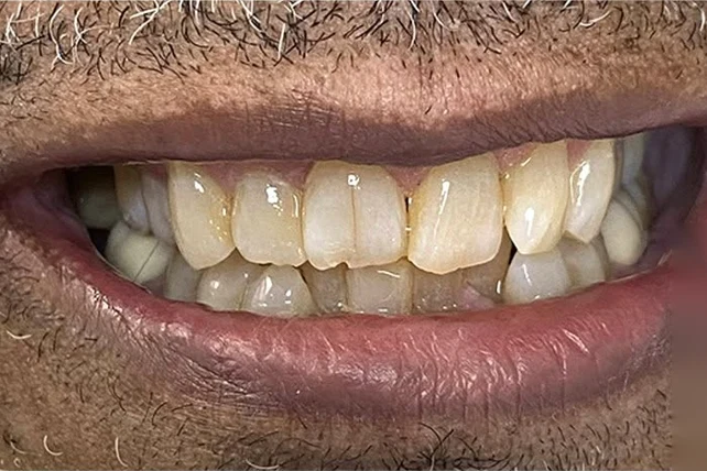 Before smile transformation treatment at SmilePro Dental, Dearborn Heights MI
