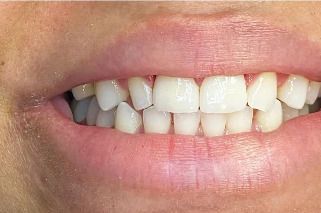 After smile transformation treatment at SmilePro Dental, Dearborn Heights MI