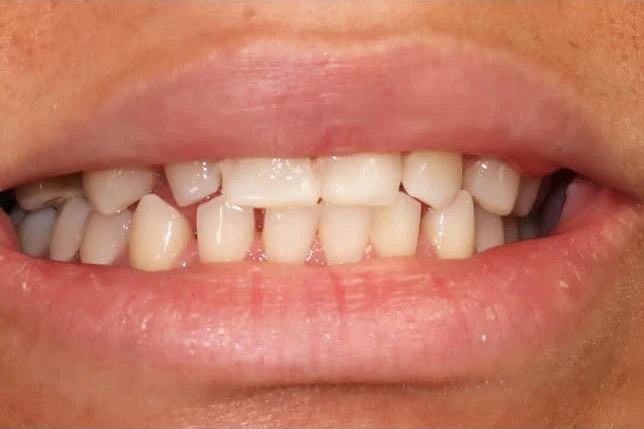 Before smile transformation treatment at SmilePro Dental, Dearborn Heights MI