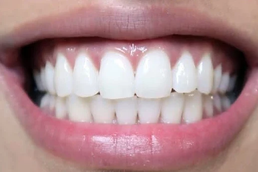 After zoom teeth whitening treatment at SmilePro Dental, Dearborn Heights MI