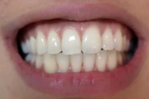 Before zoom teeth whitening treatment at SmilePro Dental, Dearborn Heights MI