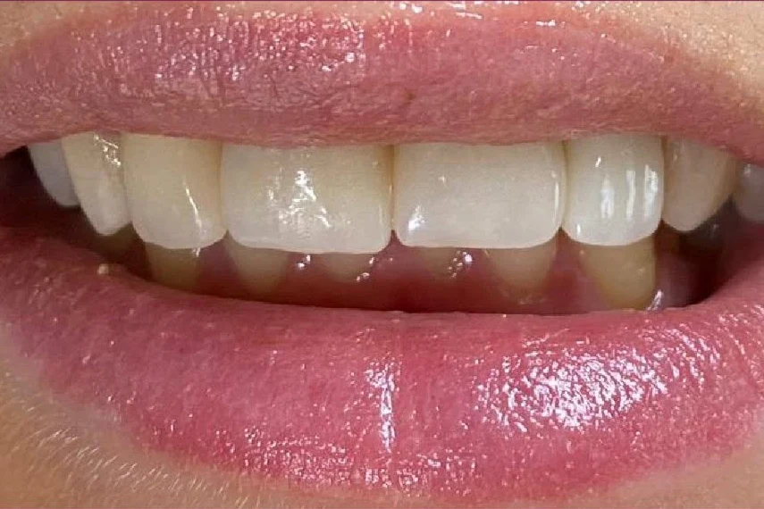 After smile transformation treatment at SmilePro Dental, Dearborn Heights MI