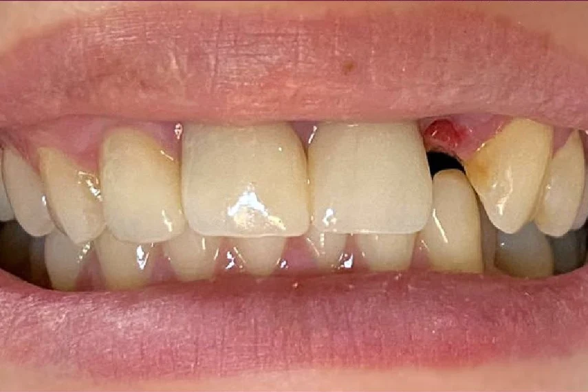Before smile transformation treatment at SmilePro Dental, Dearborn Heights MI
