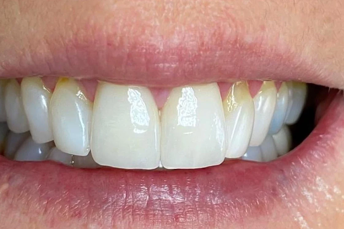 After smile transformation treatment at SmilePro Dental, Dearborn Heights MI