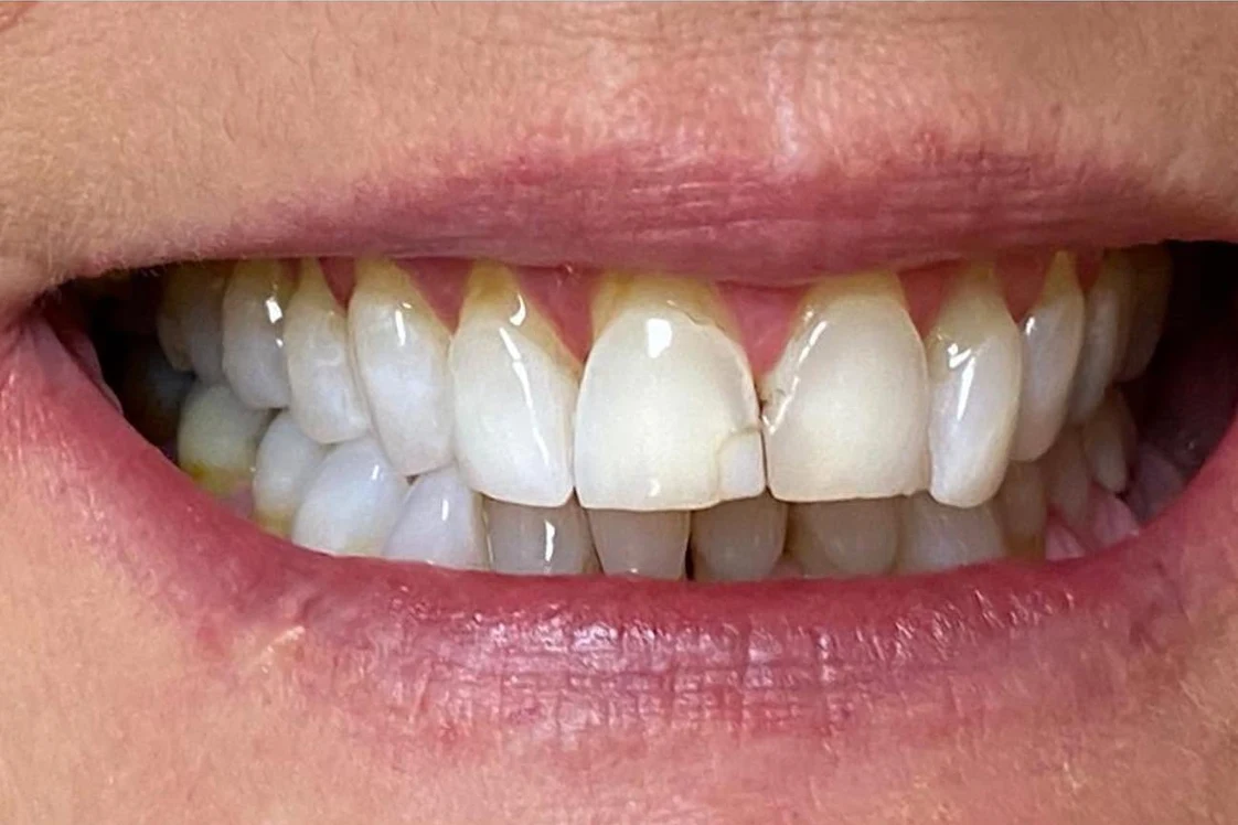 Before smile transformation treatment at SmilePro Dental, Dearborn Heights MI